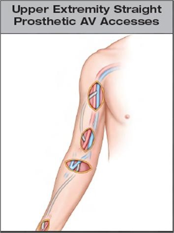 Peripheral Grafts